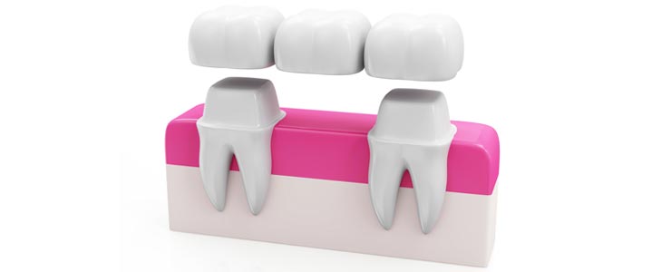 Chestermere Dental Bridges