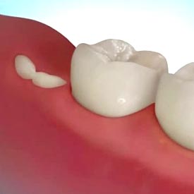 The Single Strategy To Use For Wisdom Teeth Dentist