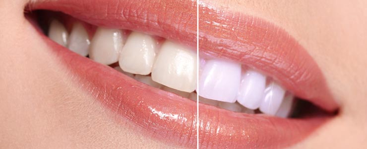 Chestermere Teeth Whitening