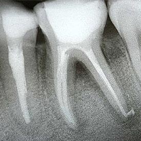 Chestermere Root Canal