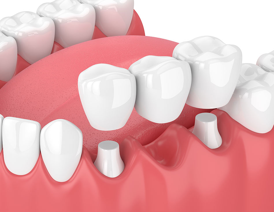 How are Dental Bridges | Chestermere Dental | Family Dentist | Chestermere AB