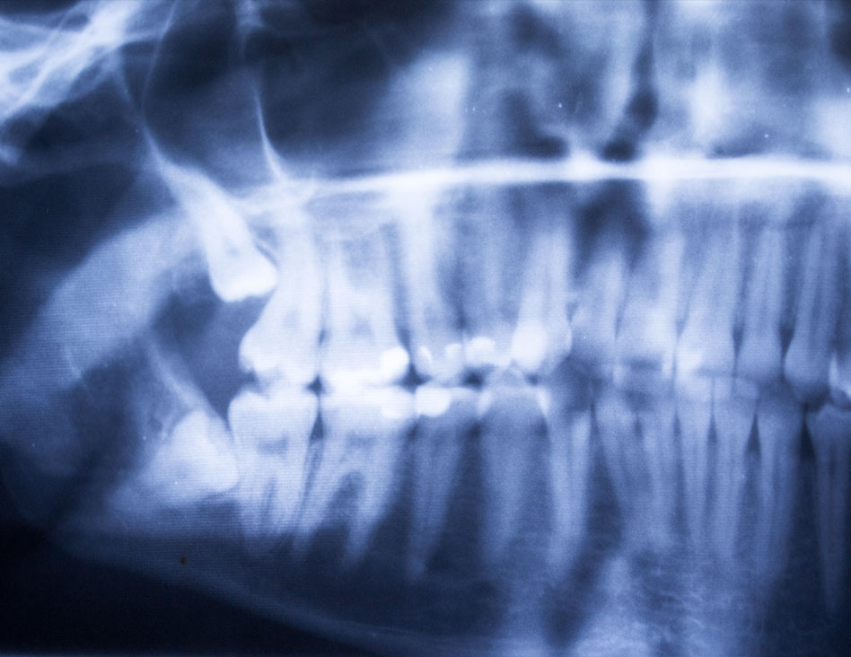 Impacted Wisdom Teeth | Chestermere Dental | General Dentist Chestermere AB