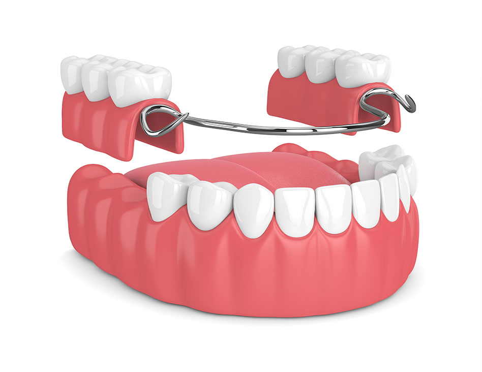 Partial Dentures | Chestermere Dental | General and Family Dentist Chestermere AB