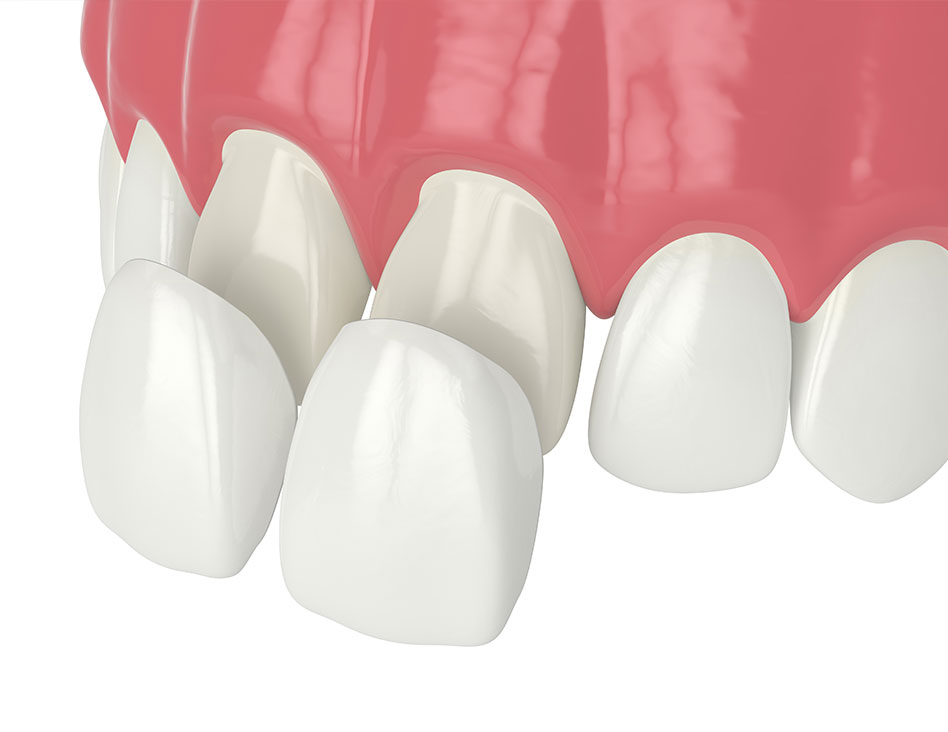 What are porcelain veneers | Chestermere Dental | Cosmetic Dentist Chestermere AB