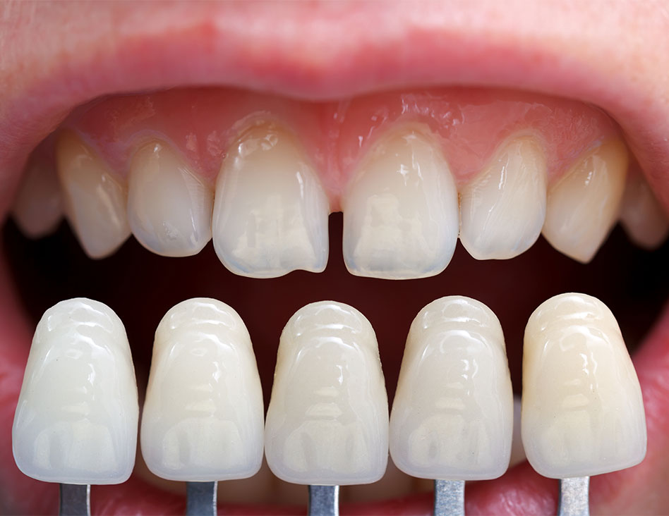 What are porcelain veneers | Chestermere Dental | Family Dentist Chestermere AB