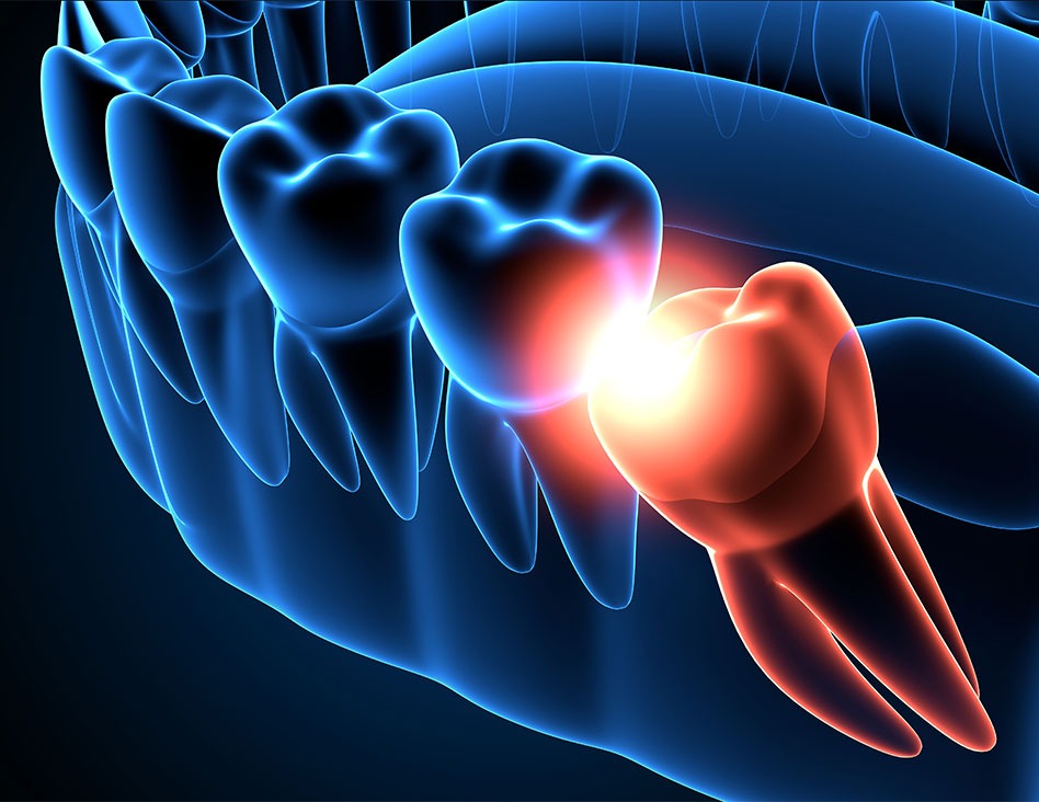 What are Wisdom Teeth | Chestermere Dental | General and Family Dentist Chestermere AB