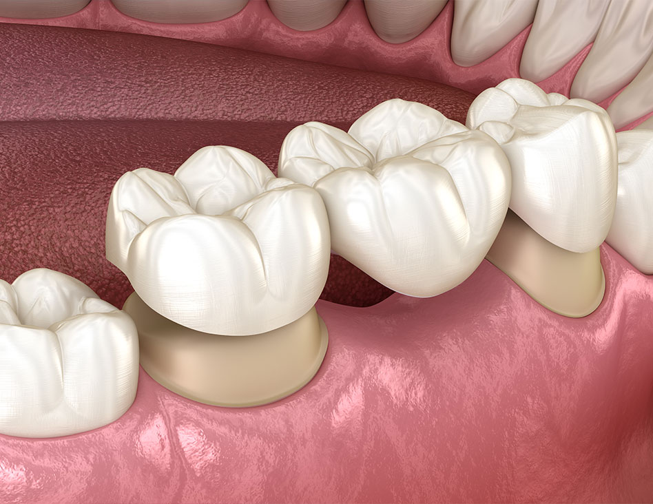 Dental Bridges | Cosmetic Dentistry | Chestermere Dental | Chestermere AB