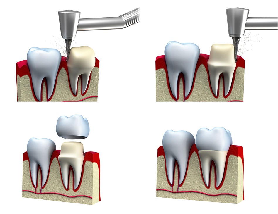 What is a Dental Crown | Chestermere Dental | General & Family Dentist | Chestermere AB