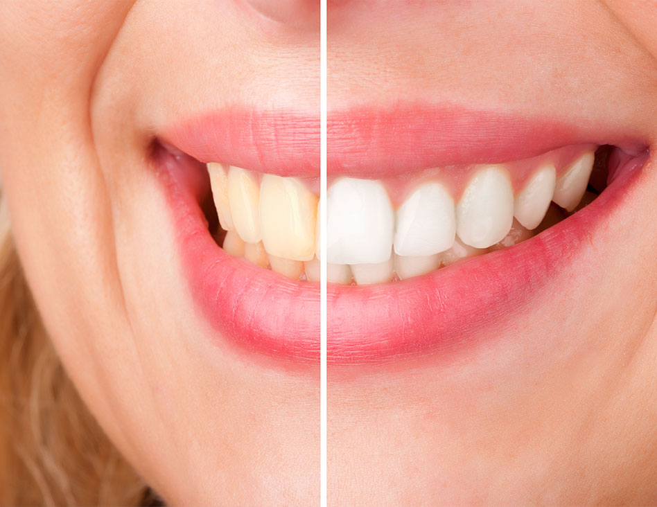What is teeth whitening | Chestermere Dental | Cosmetic Dentist Chestermere AB