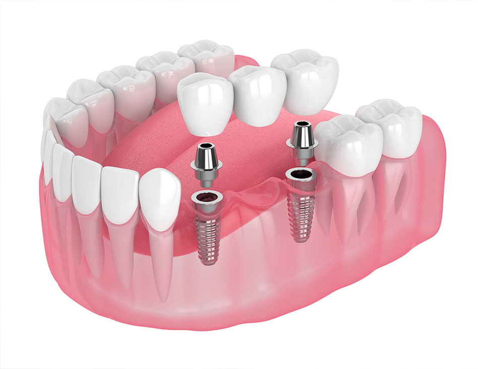 Tooth Extraction Process | Chestermere Dental | General and Family Dentist Chestermere AB