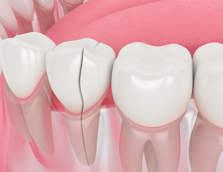 When Might a Dental Crowns | Chestermere Dental | General Dentist Chestermere AB