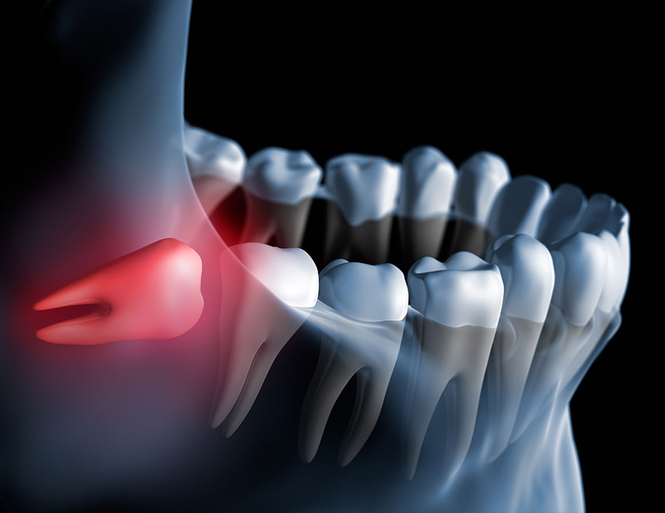 Chestermere Wisdom Teeth Removal | General Dentist | Chestermere Dental