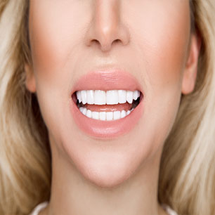 Porcelain Veneers | Chestermere Dental | General Dentist Chestermere AB