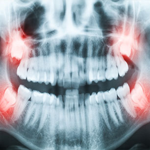 Chestermere Wisdom Teeth Extraction | Chestermere Dental | General and Family Dentist