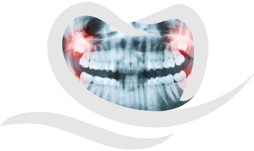 Wisdom Teeth Extraction | Chestermere Dental | General Dentist Chestermere AB